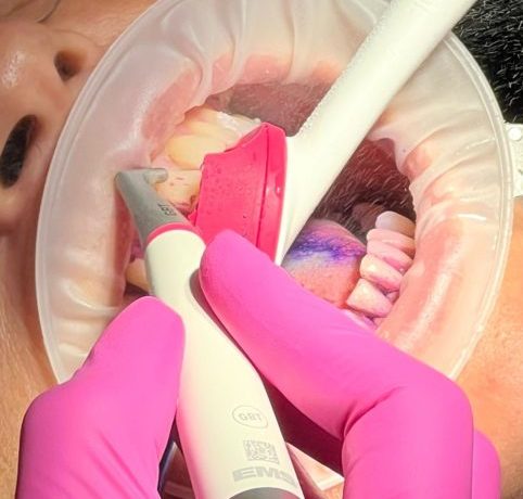 GUIDED BIOFILM THERAPY (GBT)